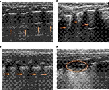 The value of lung ultrasound score in neonatal respiratory distress syndrome: a prospective diagnostic cohort study